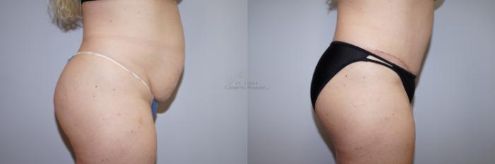 Before & After Tummy Tuck Case 294 Left Side View in St. Louis, MO