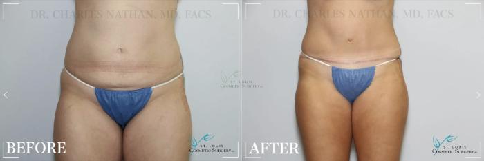 Before & After Tummy Tuck Case 320 View #1 View in St. Louis, MO