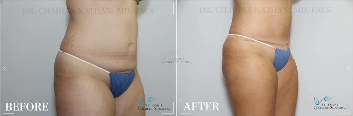 Before & After Tummy Tuck Case 320 View #2 View in St. Louis, MO