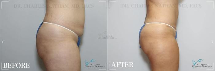 Before & After Tummy Tuck Case 320 View #3 View in St. Louis, MO