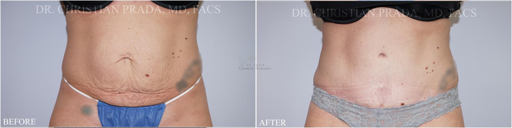 Before & After Tummy Tuck Case 369 Front View in St. Louis, MO