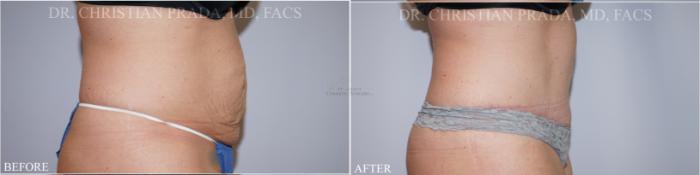 Before & After Tummy Tuck Case 369 Left Side View in St. Louis, MO