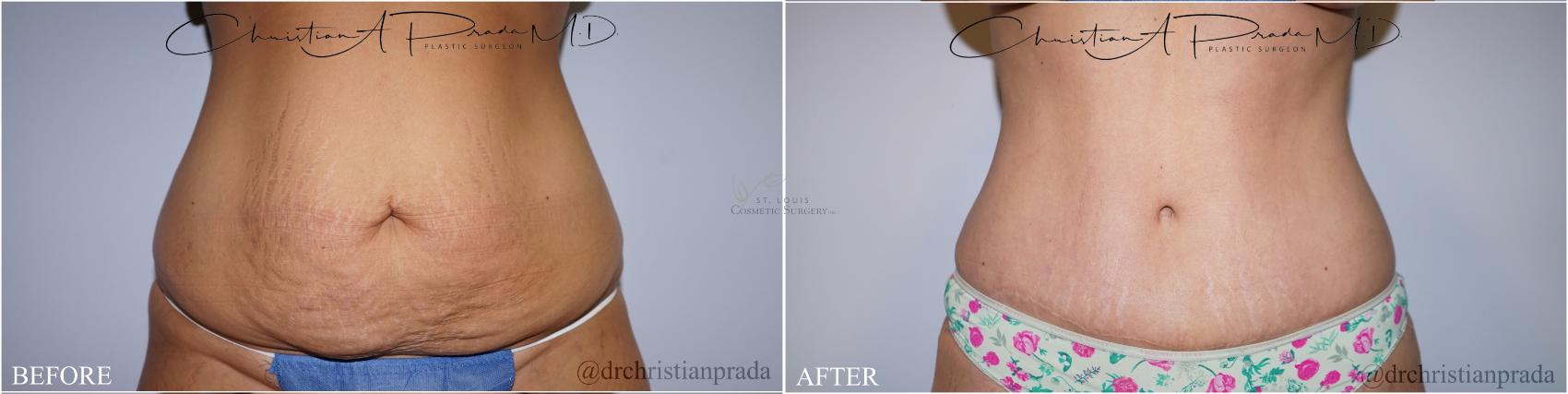 Before & After Tummy Tuck Case 373 Front View in St. Louis, MO