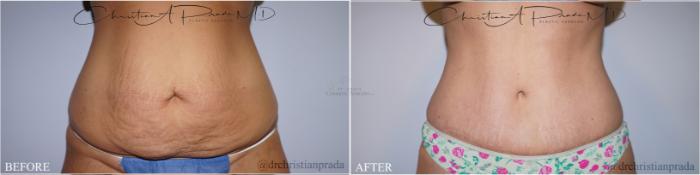 Before & After Tummy Tuck Case 373 Front View in St. Louis, MO