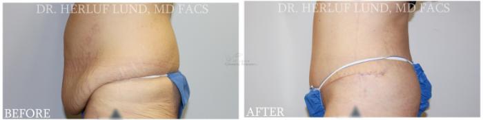 Before & After Tummy Tuck Case 377 Right Side View in St. Louis, MO