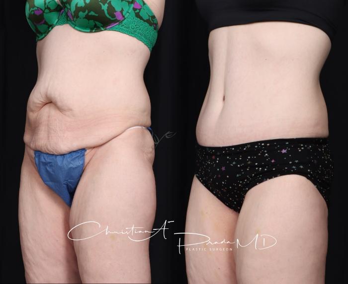 Before & After Tummy Tuck Case 400 Left Oblique View in St. Louis, MO