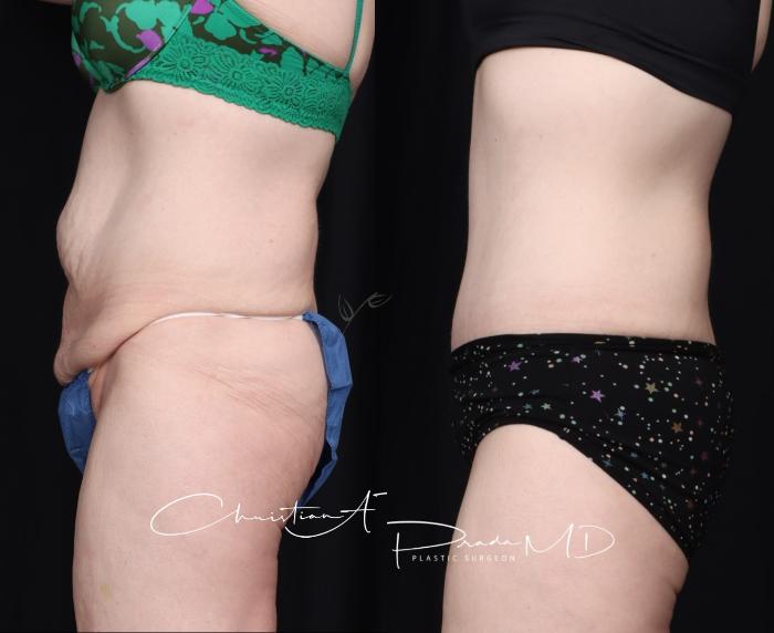 Before & After Tummy Tuck Case 400 Left Side View in St. Louis, MO