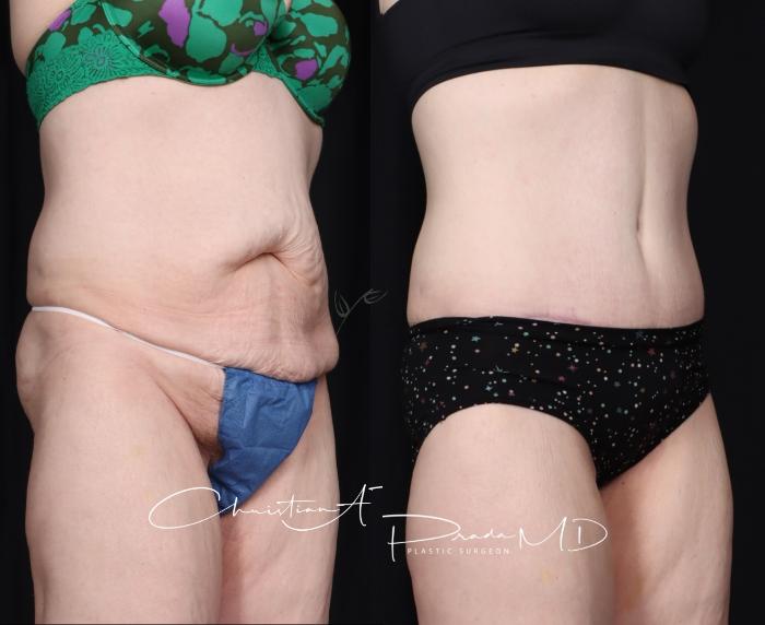 Before & After Tummy Tuck Case 400 Right Oblique View in St. Louis, MO