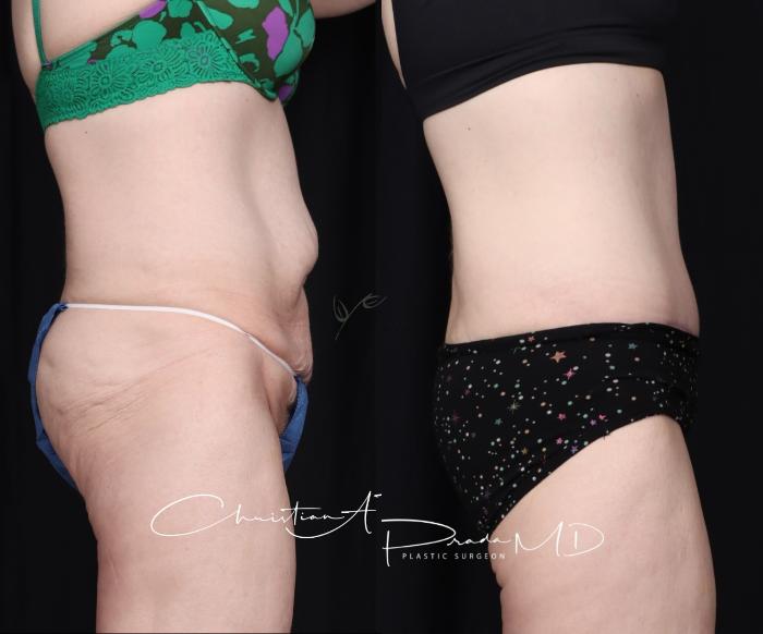 Before & After Tummy Tuck Case 400 Right Side View in St. Louis, MO