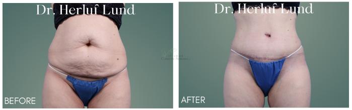Before & After Tummy Tuck Case 410 Front View in St. Louis, MO