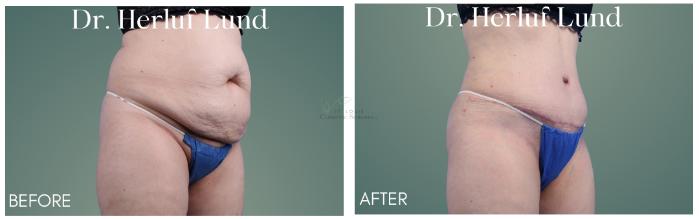 Before & After Tummy Tuck Case 410 Left Oblique View in St. Louis, MO
