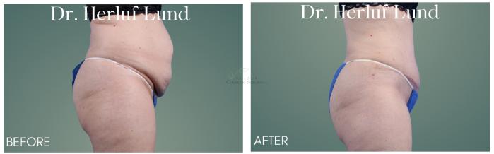 Before & After Tummy Tuck Case 410 Left Side View in St. Louis, MO