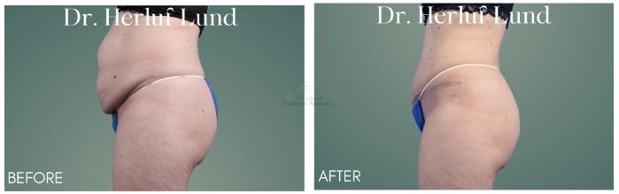 Before & After Tummy Tuck Case 410 Right Side View in St. Louis, MO
