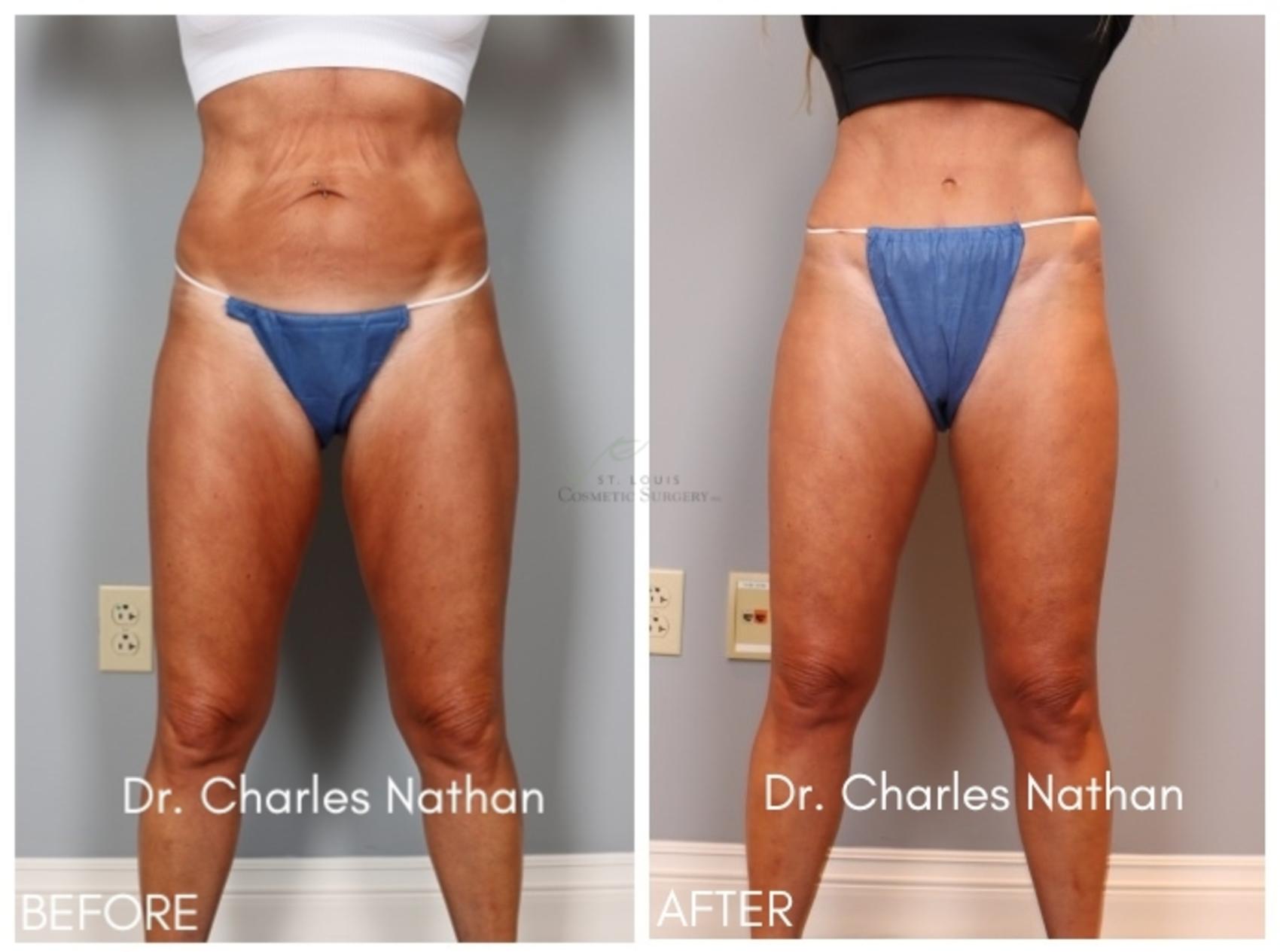 Before & After Tummy Tuck Case 416 Front View in St. Louis, MO
