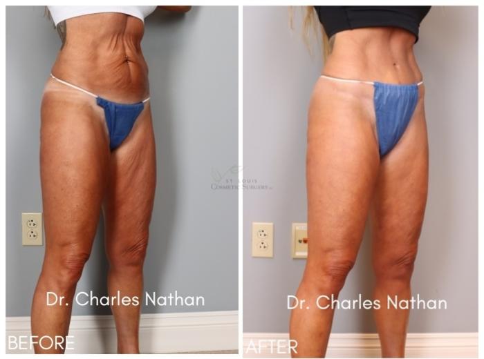 Before & After Tummy Tuck Case 416 Left Oblique View in St. Louis, MO