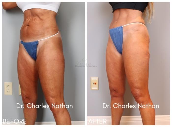 Before & After Tummy Tuck Case 416 Right Oblique View in St. Louis, MO