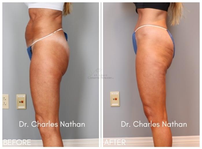 Before & After Tummy Tuck Case 416 Right Side View in St. Louis, MO