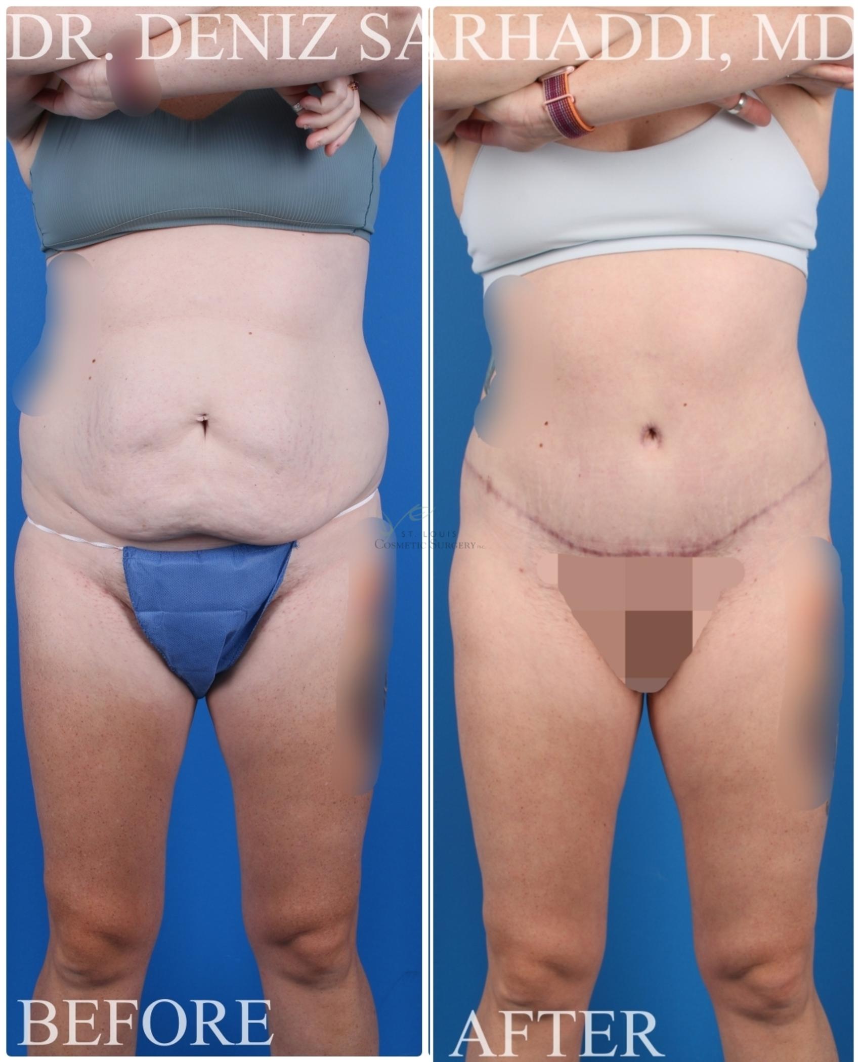 Before & After Tummy Tuck Case 421 Front View in St. Louis, MO