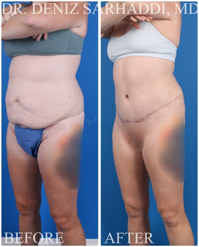 Before & After Tummy Tuck Case 421 Right Oblique View in St. Louis, MO