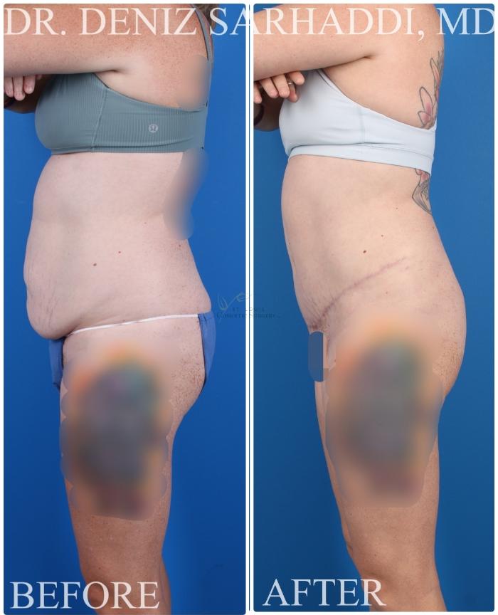 Before & After Tummy Tuck Case 421 Right Side View in St. Louis, MO
