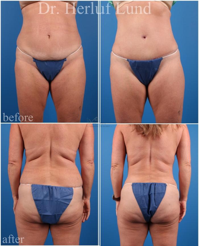 Before & After Tummy Tuck Case 440 Front View in St. Louis, MO