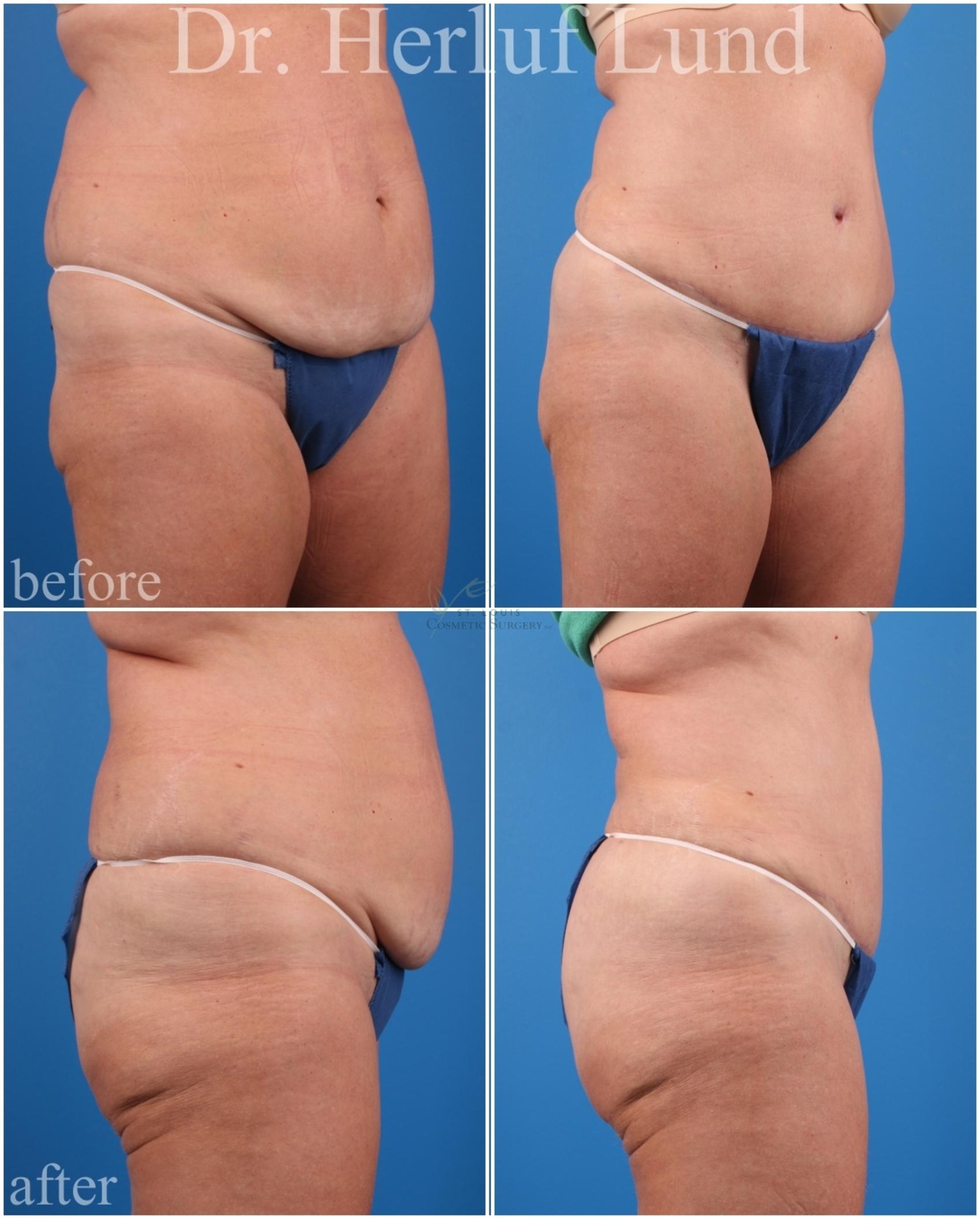 Before & After Tummy Tuck Case 440 Right Oblique View in St. Louis, MO