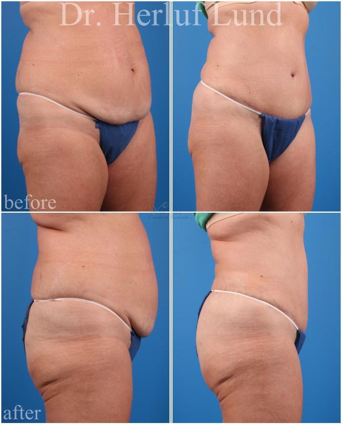 Before & After Liposuction Case 440 Right Oblique View in St. Louis, MO