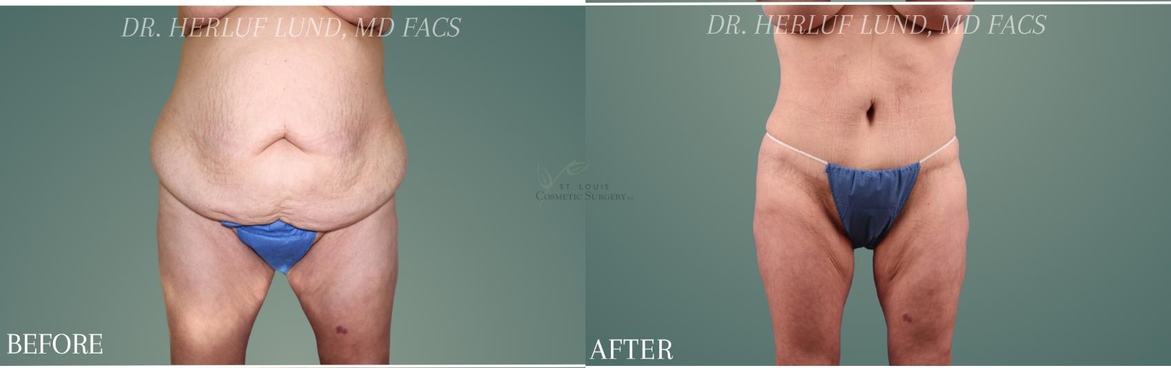 Before & After Tummy Tuck Case 441 Front View in St. Louis, MO