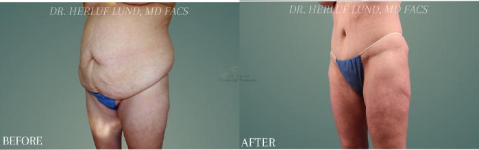 Before & After Tummy Tuck Case 441 Left Oblique View in St. Louis, MO