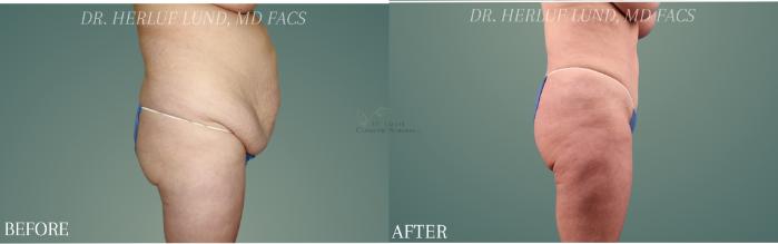 Before & After Tummy Tuck Case 441 Right Side View in St. Louis, MO
