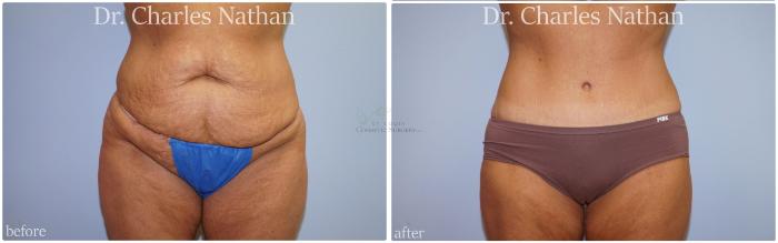 Before & After Tummy Tuck Case 449 Front View in St. Louis, MO