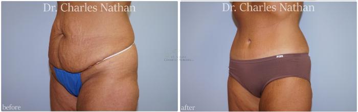 Before & After Tummy Tuck Case 449 Left Oblique View in St. Louis, MO