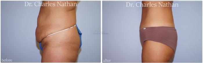 Before & After Tummy Tuck Case 449 Left Side View in St. Louis, MO