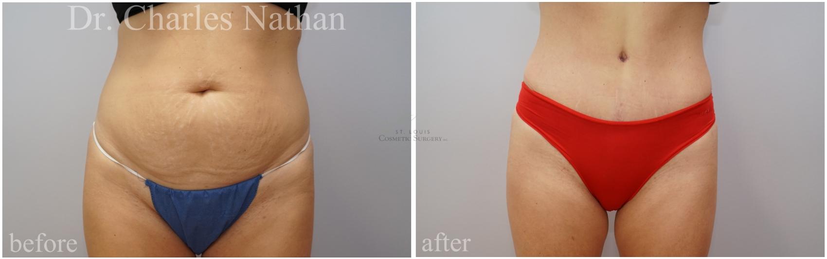 Before & After Tummy Tuck Case 453 Front View in St. Louis, MO