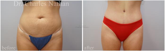 Before & After Tummy Tuck Case 453 Front View in St. Louis, MO