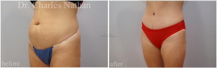Before & After Tummy Tuck Case 453 Left Oblique View in St. Louis, MO