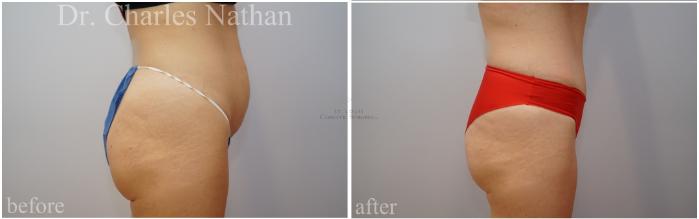 Before & After Tummy Tuck Case 453 Right Side View in St. Louis, MO