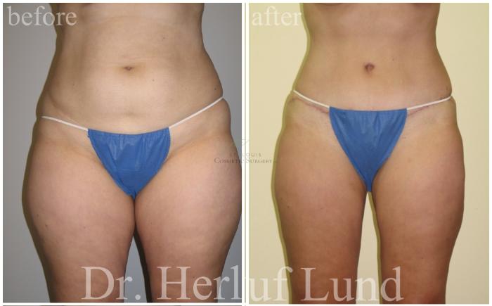 Before & After Tummy Tuck Case 460 Front View in St. Louis, MO