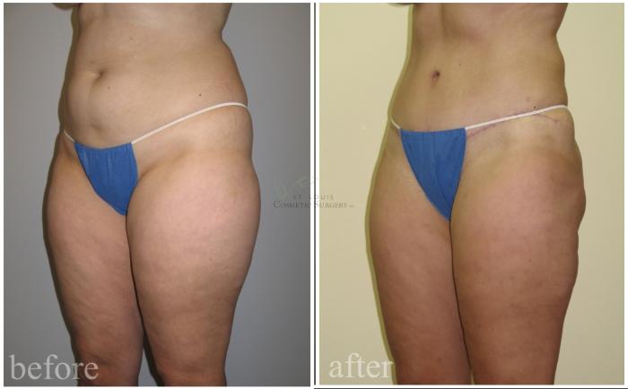Before & After Tummy Tuck Case 460 Left Oblique View in St. Louis, MO