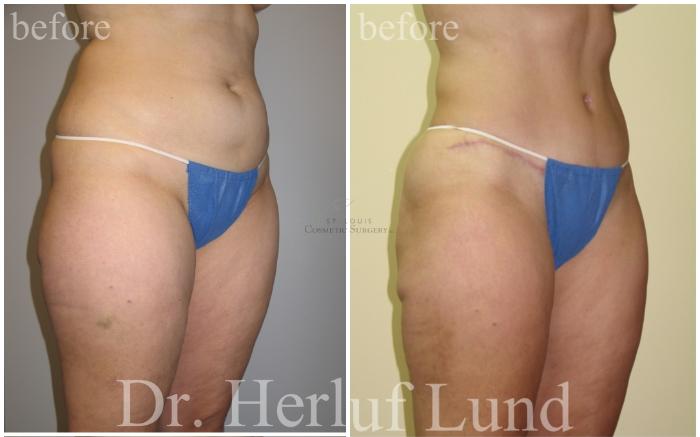Before & After Tummy Tuck Case 460 Right Oblique View in St. Louis, MO