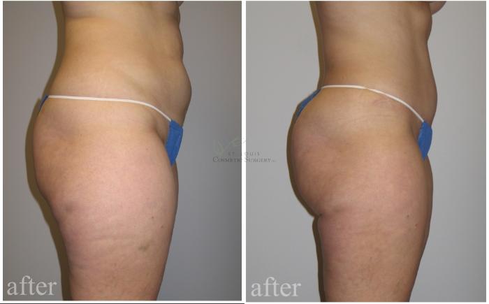 Before & After Tummy Tuck Case 460 Right Side View in St. Louis, MO