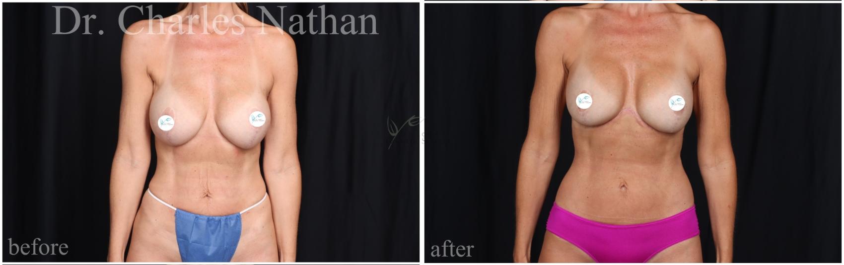 Before & After Tummy Tuck Case 465 Front View in St. Louis, MO