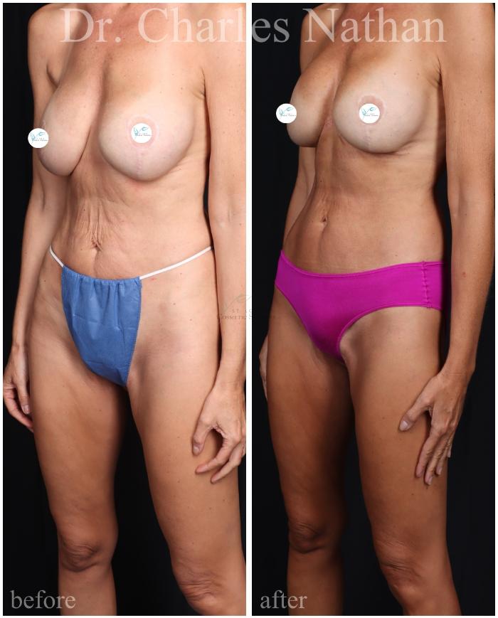Before & After Tummy Tuck Case 465 Left Oblique View in St. Louis, MO