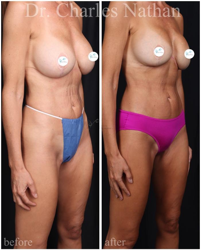 Before & After Tummy Tuck Case 465 Right Oblique View in St. Louis, MO