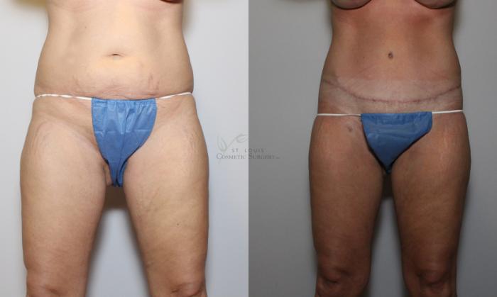Before & After Tummy Tuck Case 77 View #1 View in St. Louis, MO