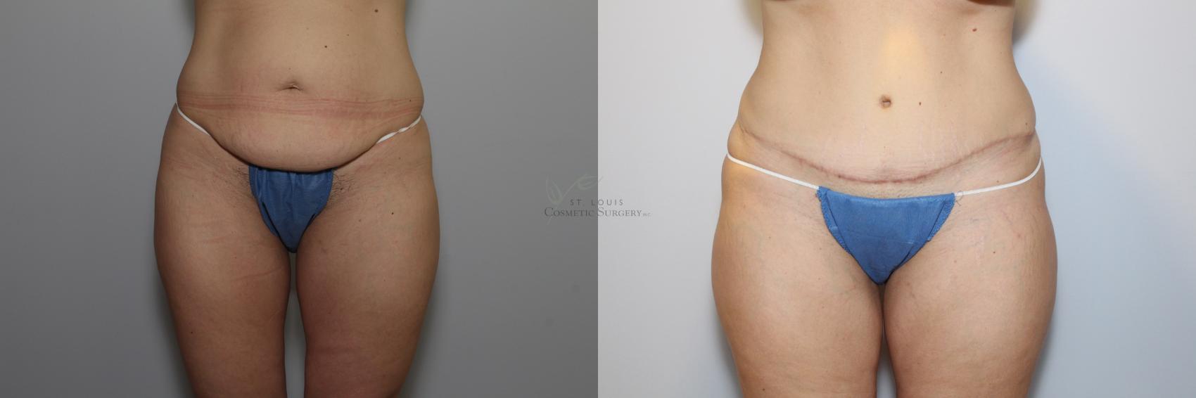 Before & After Tummy Tuck Case 86 View #1 View in St. Louis, MO