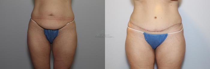 Before & After Tummy Tuck Case 86 View #1 View in St. Louis, MO