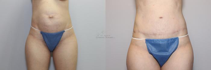 Before & After Tummy Tuck Case 87 View #1 View in St. Louis, MO