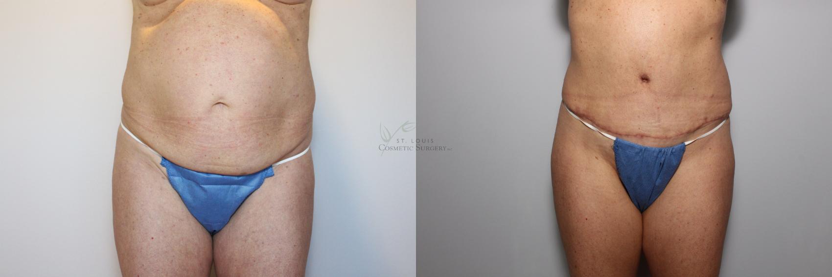 Before & After Tummy Tuck Case 88 View #1 View in St. Louis, MO