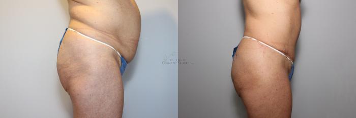 Before & After Tummy Tuck Case 88 View #2 View in St. Louis, MO